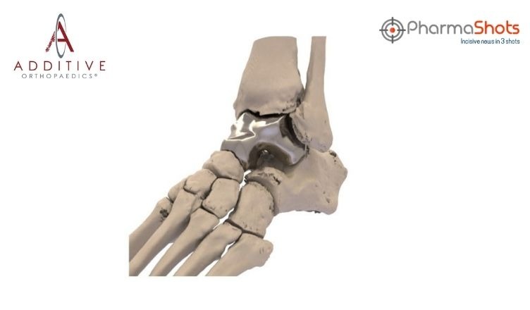 The US FDA Approves Patient Specific Talus Spacer to Treat AVN of Ankle Joint as a Humanitarian Use Device